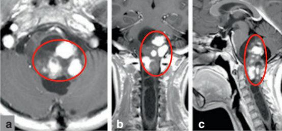 一个意外查出女孩脑中的巨瘤，看到核磁后医生冷汗直流……