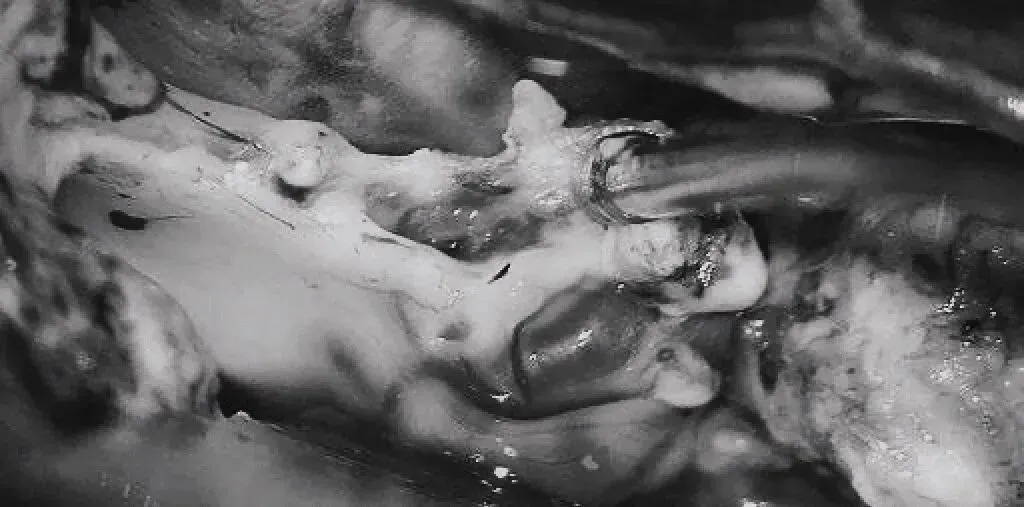 将AVM后缘向前牵离穹窿。