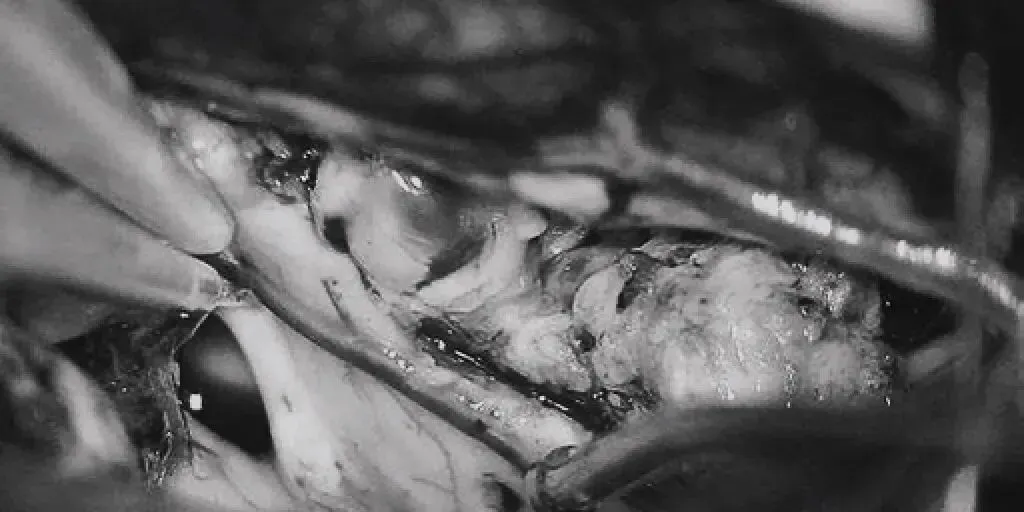 在透明隔底部保留FoM、穹窿和右侧SepV。