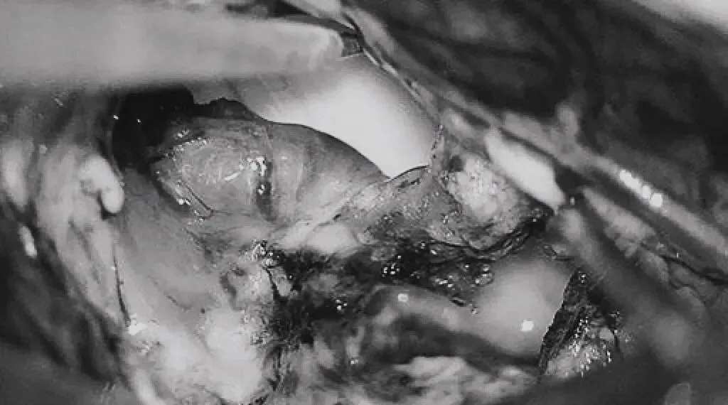 引流静脉变黑。