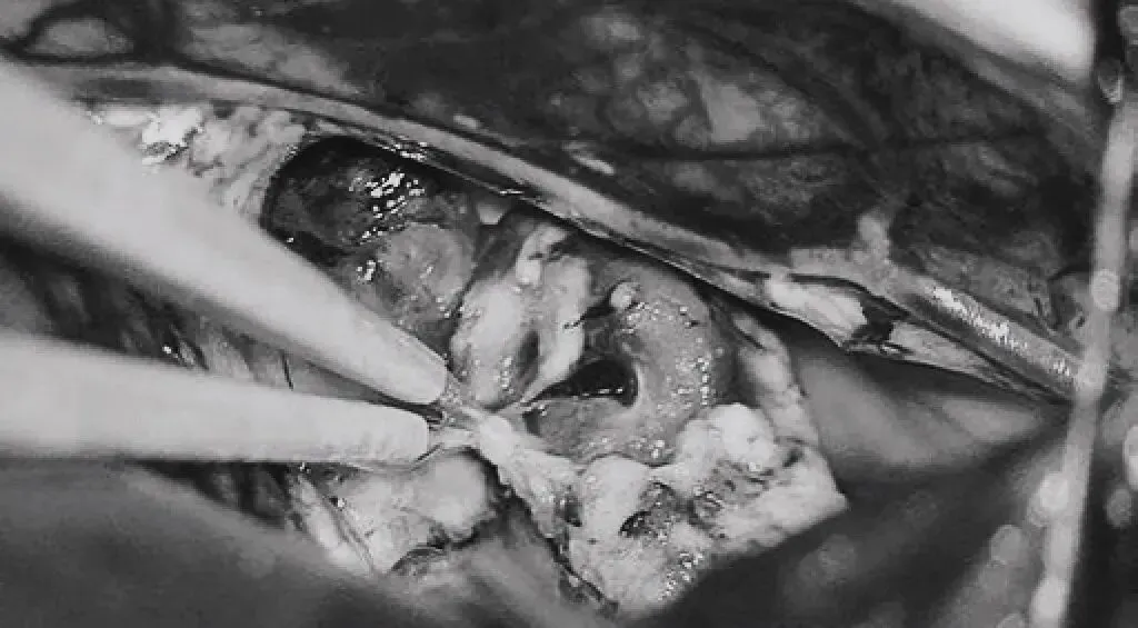 引流静脉进入ICV处电凝。完全切除AVM。