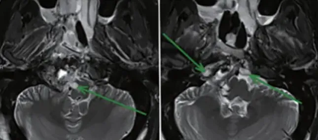 第一阶段经鼻内镜手术结束