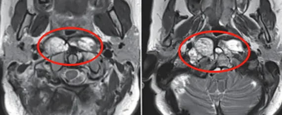 当开颅与经鼻双双失效，第四次手术前医生对她说：我还有一个办法……