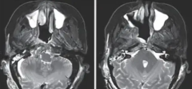 第二阶段开颅手术结束