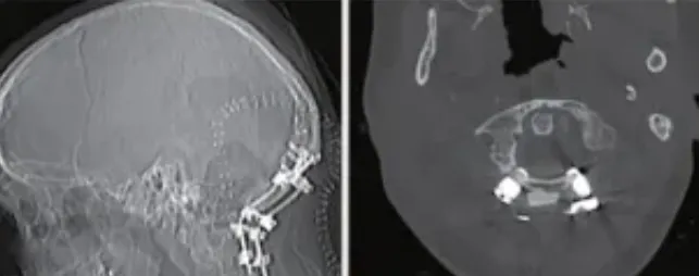 最后，由于右侧枕髁完全被肿瘤侵犯，因此，在肿瘤切除后，还需要进行手术融合稳定。