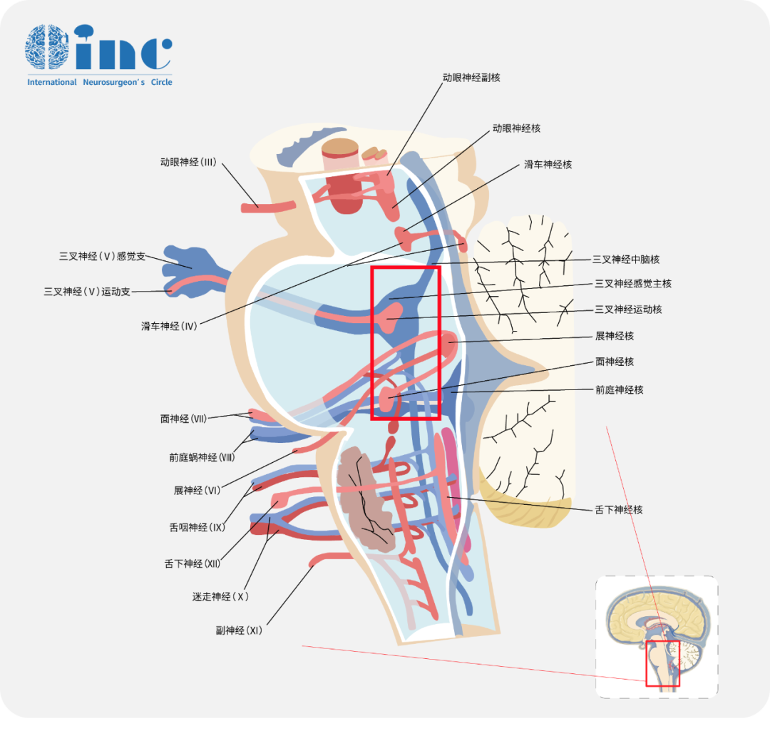 脑干出血术后，偏瘫、面瘫、吞咽困难还能恢复吗？他勇闯“脑干禁区”救回一命