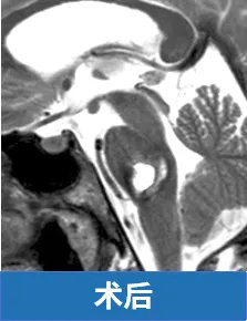 术后
