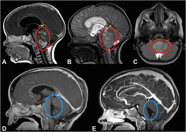 18个月宝宝频繁呕吐，过了3个月父母才知道竟是脑瘤在作祟！
