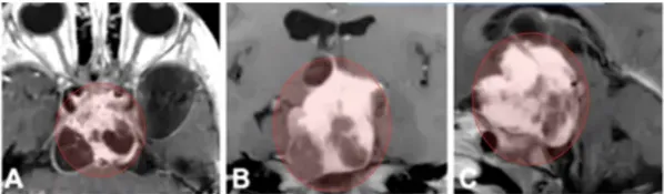 MRI显示其鞍上区存在部分囊变并明显强化的巨大占位病变，肿瘤甚至延伸至左侧颞叶（图A–C）