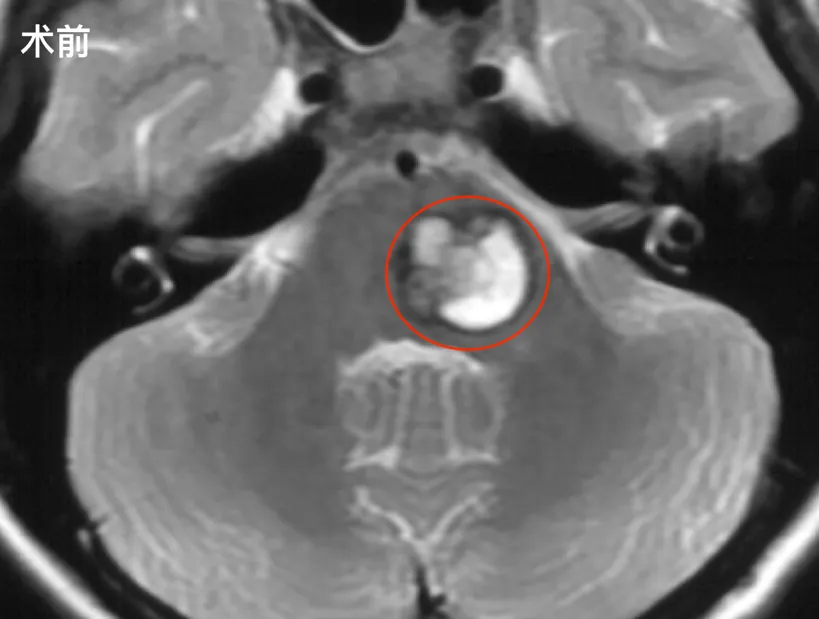学霸女儿说看字有重影时我没在意，直到查出脑干出血，我才知什么是绝望！