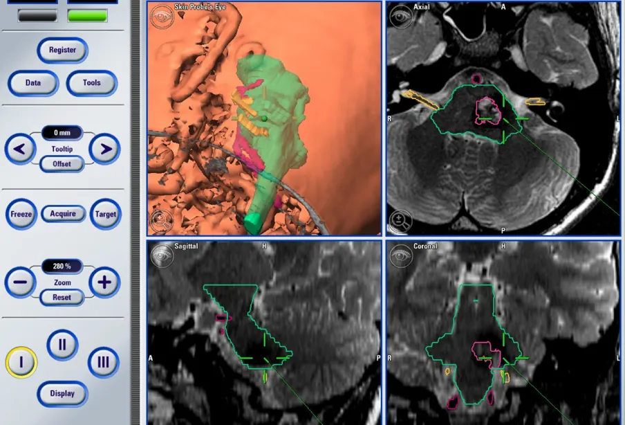术前MR，发现脑干海绵状血管瘤，伴有脑出血。