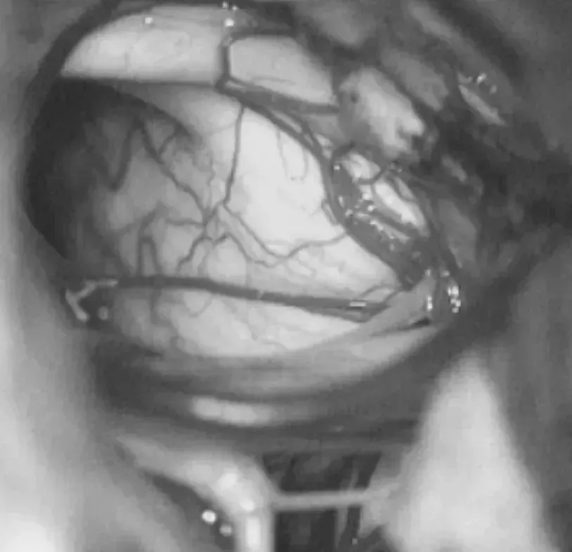 术中开颅、切开硬膜后，暴露脑干，用电生理监测术中探测核团所在。