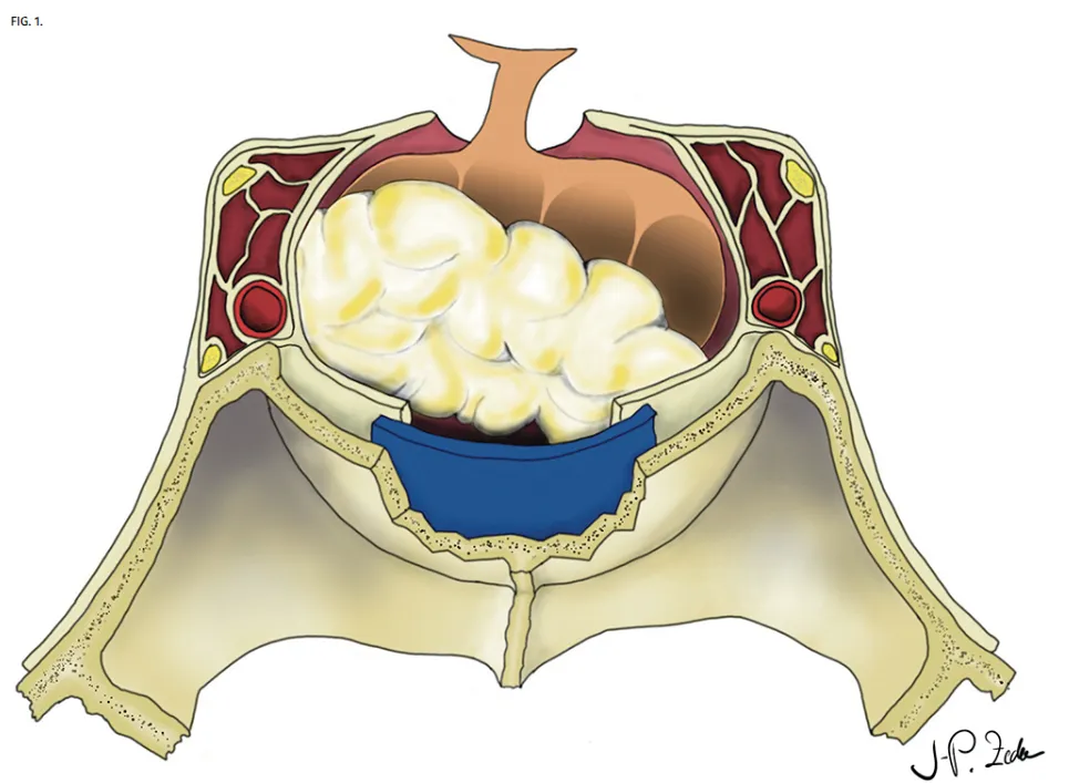 图：冠状位示意图显示垂体病变切除后的鞍区结构，可见PDS薄膜（聚二氧六环酮膜）被置于骨性鞍底与硬膜之间。