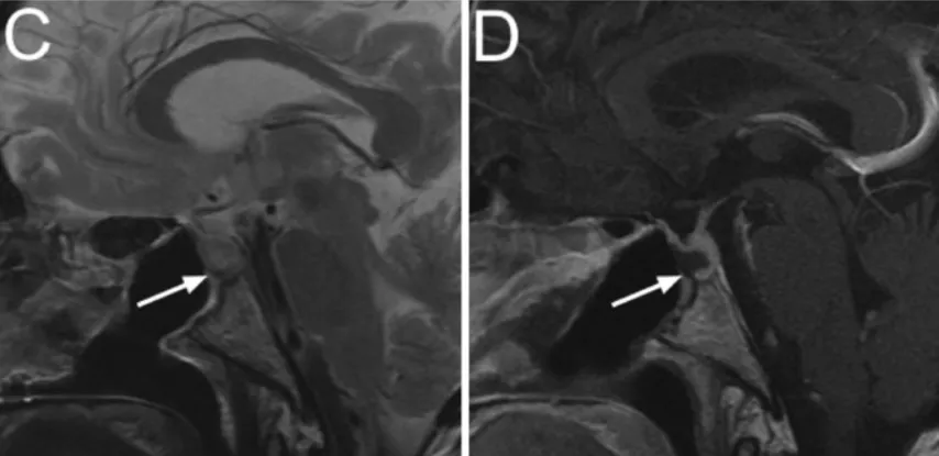 C、D：术后即刻影像