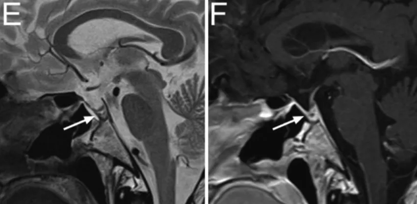 E、F：术后3个月复查矢状位T2WI与T1WI，可见PDS薄膜仍位于原位（箭头）。