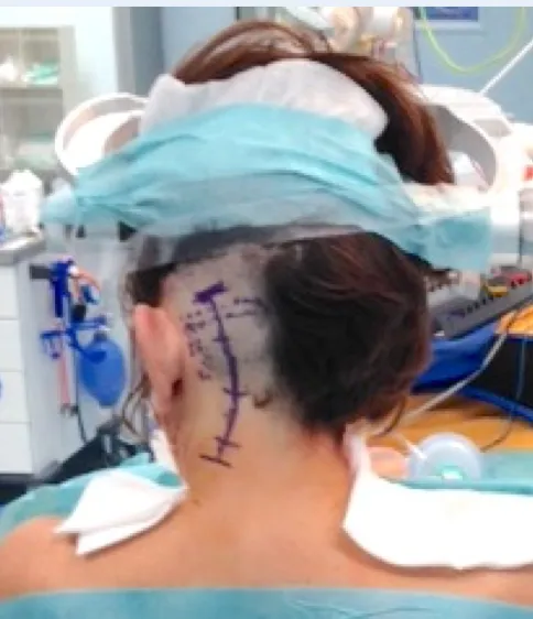 患者半坐位及体表手术入路切口标记