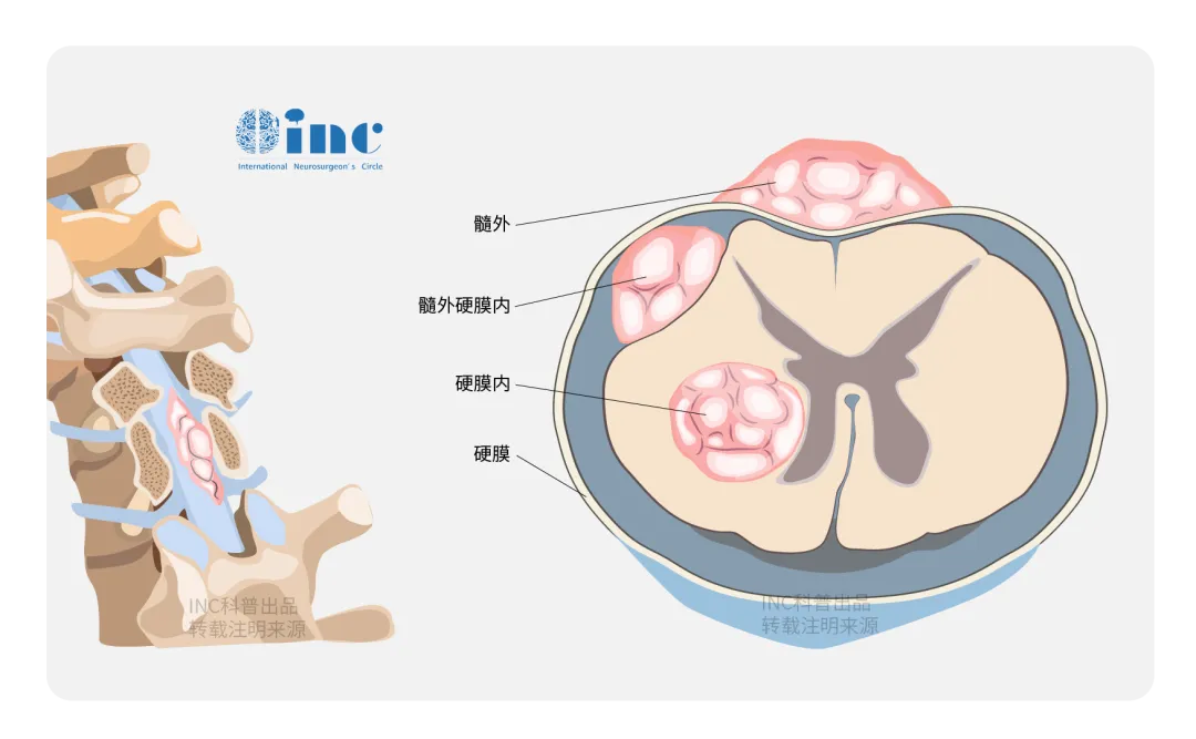 仅有20%的脊索瘤能5年不复发，但我们女儿做到10年不复发啦！