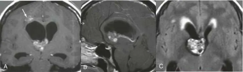 34岁的我查出2个脑瘤，幸好可以一次手术切完