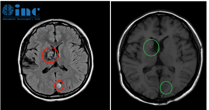 术前术后影像对比（红色术前，绿色术后）