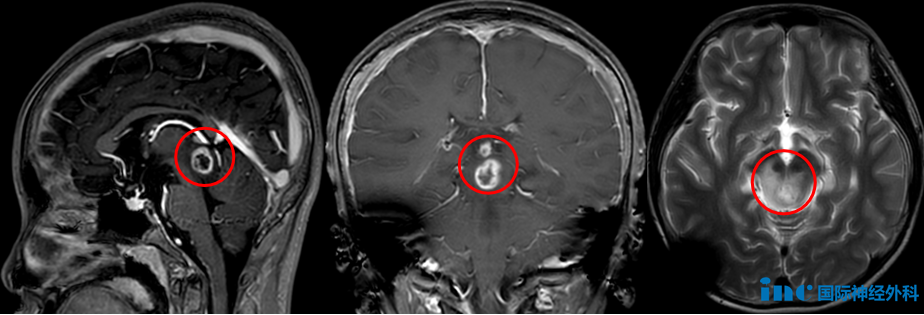 脑干胶质瘤该如何应对？