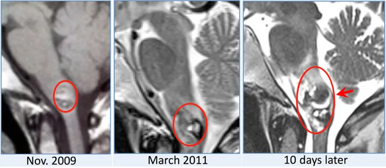 突发脑出血几近瘫痪被送进ICU的她，靠这场手术改写了自己的生死剧本！