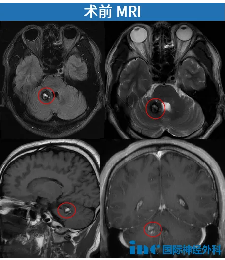 脑血管瘤术后可能瘫？我这靠手吃饭的设计师懵了！