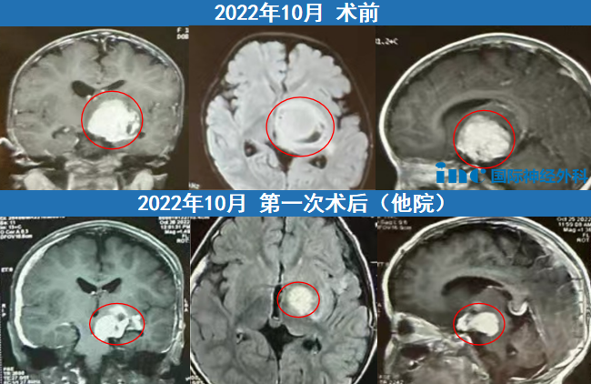 儿童基底节区胶质瘤