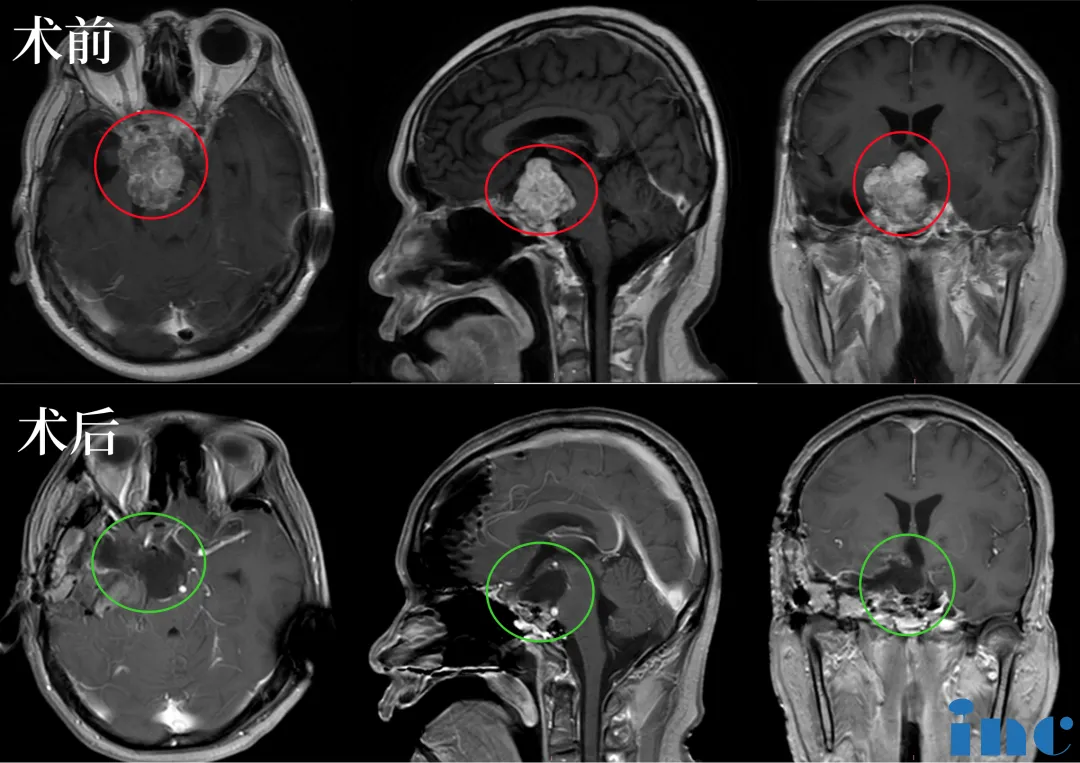 脊索瘤可以治好吗？影响手术切除率的关键因素有哪些？