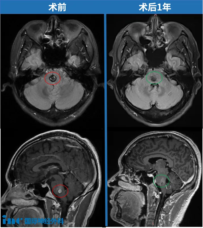 术后1年刘先生走路、骑车已与常人无异