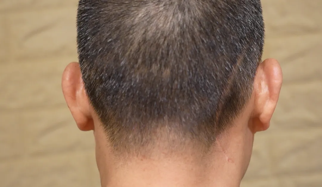 刘先生请理发师在手术切口的对侧也推一条对称的线条