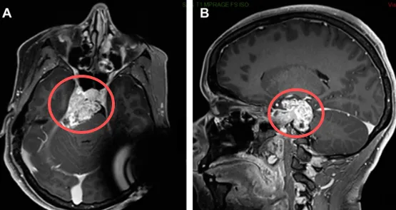 一次头部外伤，竟意外查出颅底肿瘤！脑外伤真的会导致脑瘤吗？