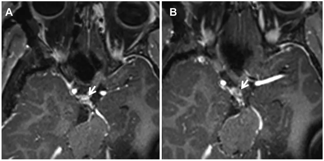 该案例来源于INC<a href='/jiaoshou/53.html' target='_blank'><u>福洛里希</u></a>教授2020年发表的论文《Oculomotor Neurofibroma:A Different Histology Implying an Unsatisfying ClinicalOutcome》。