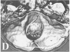 右侧椎动脉被肿瘤包绕
