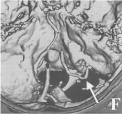 术后恢复平稳，无并发症。
