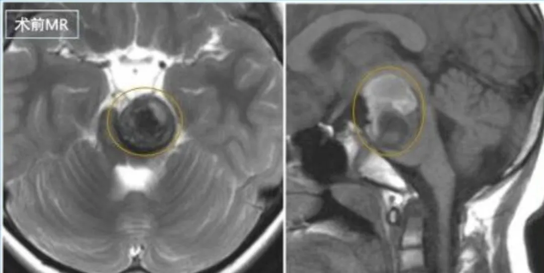 从孩子确诊脑血管瘤到逆袭为“高精力男孩”，我们这一年经历了太多！