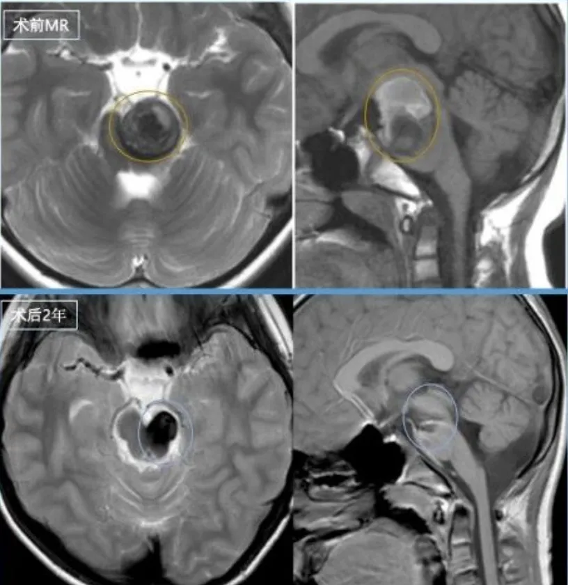 脑干海绵状血管瘤