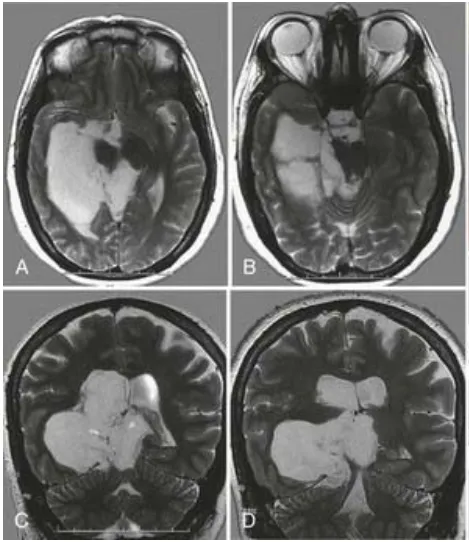 反复癫痫发作会损伤大脑吗？脑瘤导致的癫痫怎么办？