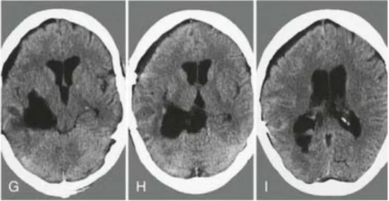 G-I：术后CT证实肿瘤已全切