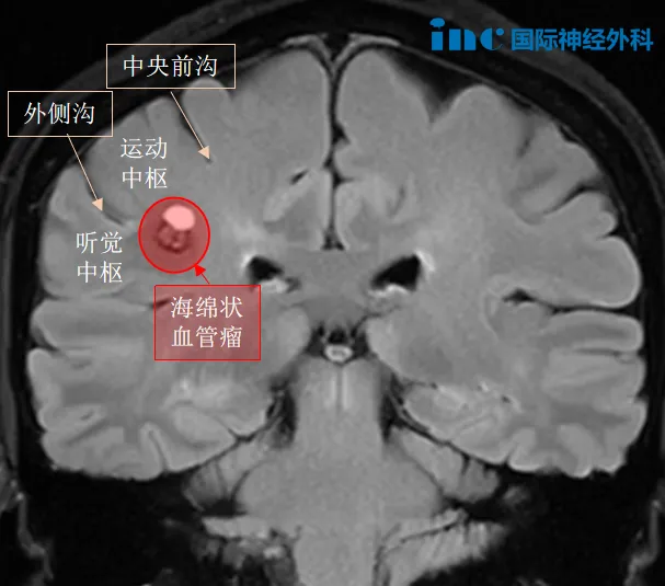 体检查出无症状脑血管瘤：48 岁女高管拒等 “癫痫突袭”，果断手术改写人生！