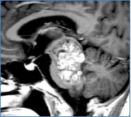 脑干手术成功率多大？开颅手术后，她如愿生下两个健康宝宝