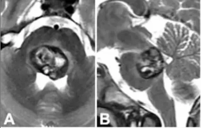 一场开颅手术，差点害我再也打不了篮球...