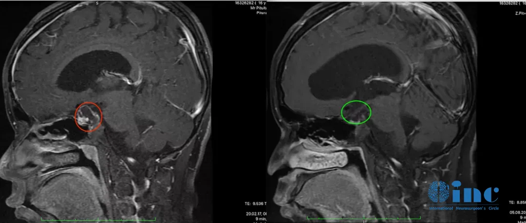 小杰的术前术后MRI对比，红色为术前肿瘤位置，绿色为术后切除效果