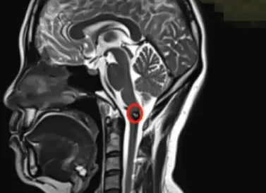 脑干-延髓海绵状血管瘤影像