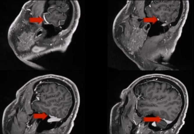 福教授采用开颅手术