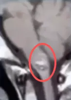 小小的血管瘤竟在10天内致人昏迷瘫痪！一场紧急救援正式启动！