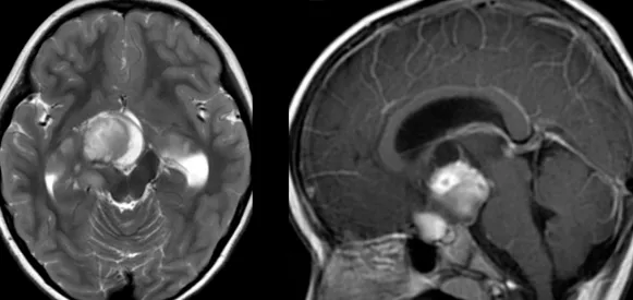 视神经-下丘脑胶质瘤