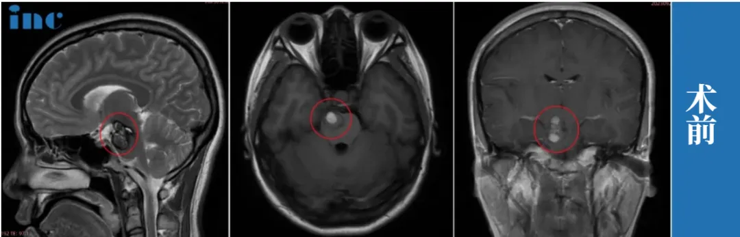 中脑-桥脑海绵状血管瘤影像