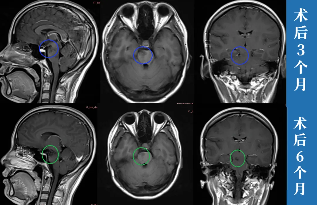 中脑-桥脑海绵状血管瘤案例