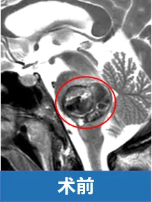 桥脑海绵状血管瘤术前