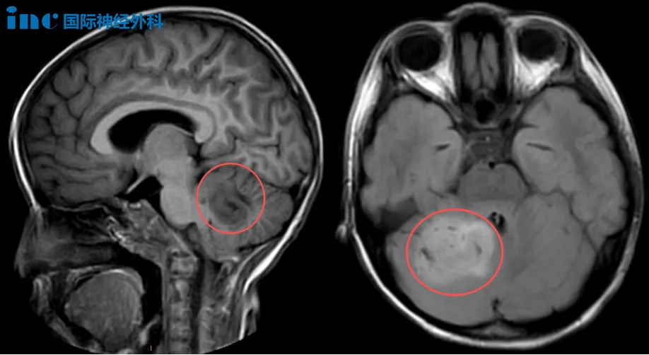 6岁女儿小脑巨瘤  　　和巴爷爷面对面交流后，我们决定手术！